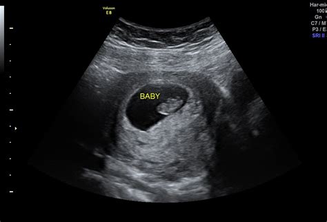 pregnant ultrasound porn|'pregnancy ultrasound' Search .